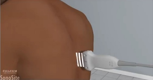 傍脊椎神経ブロック | Sonosite Institute for Point-of-Care Ultrasound